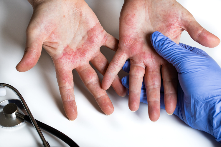 Infecciones Fúngicas de la piel